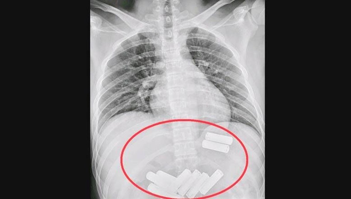 Çin'de bir kişinin yuttuğu 11 pil, endoskopiyle midesinden çıkarıldı